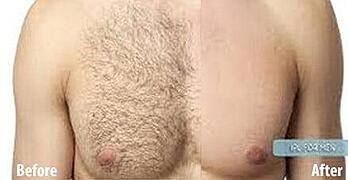 Laser Hair Removal (LHR)